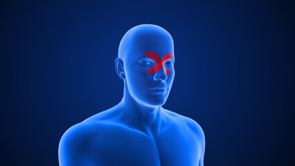 Types of Headache (Allergy Sinus) 3d illustration