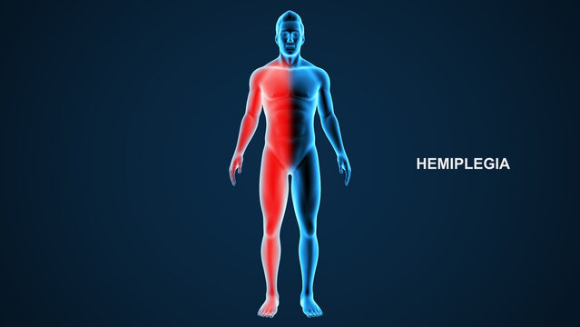 Hemiplegia type paralysis 3d Illustration