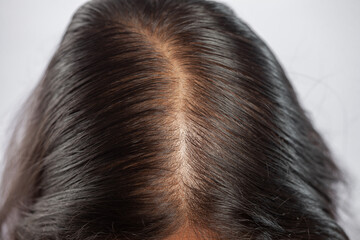macro shot of an women showing her bald patch due to hair loss
