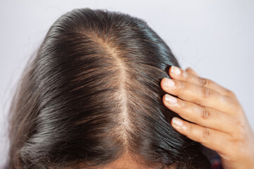adult women suffering from hair fall showing bald head scalp - obrazy, fototapety, plakaty