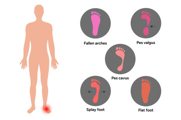 Types of deformity foot, fallen foot, flat foot, pes valgus, pes cavus, splay foot - obrazy, fototapety, plakaty