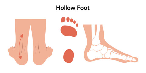 Hollow foot deformity  - obrazy, fototapety, plakaty