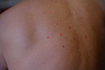 itchy rashes on skin, close-up injured male back, skin bitten by mosquitoes, damaged reddened skin,...