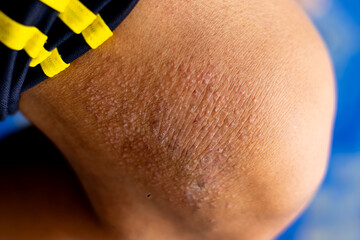 Itchy rash from an allergic reaction to your own sweat