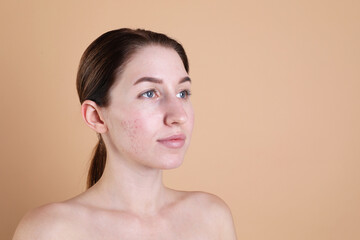 Young woman with acne problem on beige background. Space for text