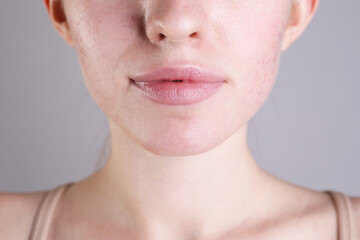 Young woman with acne problem on light grey background, closeup
