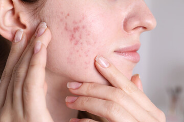 Woman with acne problem at home, closeup