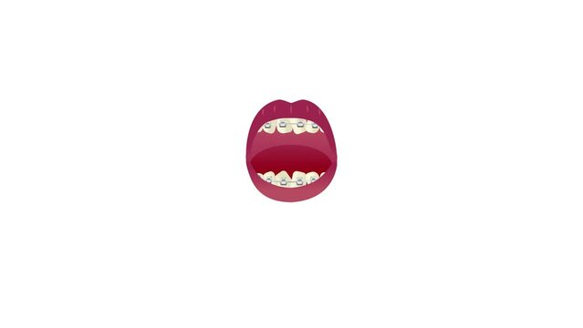 Dental braces or orthodontic cases Fitting procedure animated video, Cosmetic Dentistry footage, Fix the shapes the teeth and jaws clip,  removable aligners motion Graphics