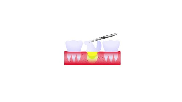 Removing Broken or infected teeth and Placing Implant or fixture animated video, abutment is placed to hold a dental prosthetic footage, Single tooth restoration treatment clip, fixed bridge animation