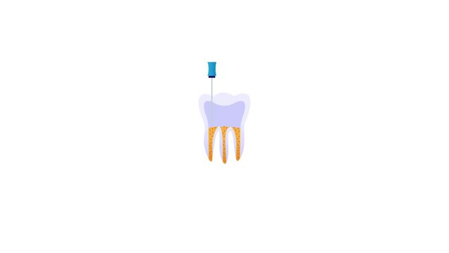 Root canal treatment procedure Explained animated video concept, Dentistry clinical examination Educational footage procedure to remove inflamed infected pulp animation Endodontic retreatment clip