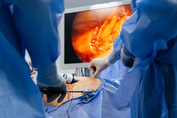 Doctor in blue sterile surgical gown doing surgery with camera and instrument. Keyhole surgery was...