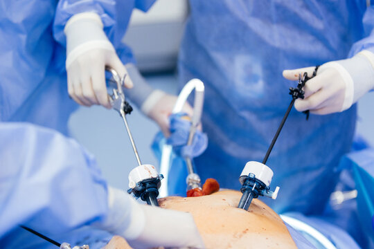 Doctor in blue sterile surgical gown doing surgery with camera and instrument. Keyhole surgery was perform in modern operating room. Advanced laparoscopy