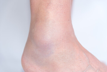 close up of sprained ankle, joint inflammation, pain, bruise - obrazy, fototapety, plakaty