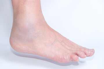 close up of sprained ankle, joint inflammation, pain