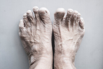 The skin is dry and rough on the feet of elderly people.