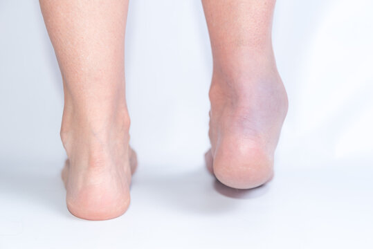 broken ankle, joint inflammation, pain, sprained foot, rehabilitation, accident