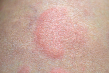 Skin allergy rash dermatitis texture close up background