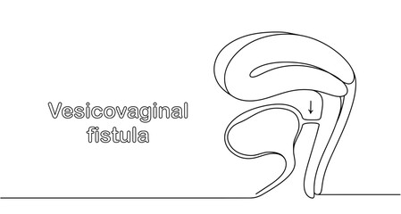 Vesicovaginal fistula - obrazy, fototapety, plakaty