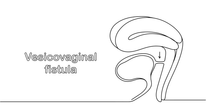 Vesicovaginal fistula