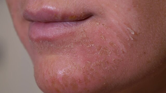 CLOSE UP, DOF: Facial skin of a young woman showing signs of severe inflammation. Lady with a damaged epidermis on her face suffers from itchy and irritated red skin caused by an allergic reaction.