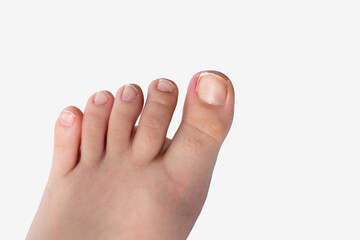 ingrown toenail, view after tamponade - obrazy, fototapety, plakaty