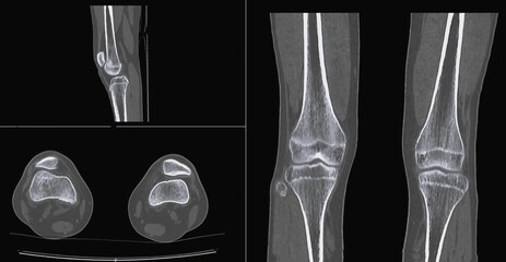  
Healthy knee, CT scan bone  - obrazy, fototapety, plakaty