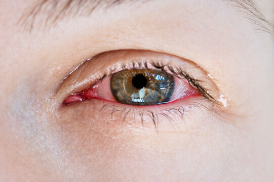 Eye infection, blood and tear closeup