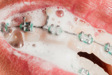 Orthodontic Care: Brushing and Cleaning Braces