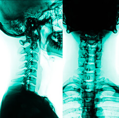 normal human cervical xray