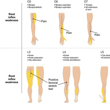 Radiculopathies pinched nerve vector illustration, pain, weakness, altered sensation, or difficulty controlling specific muscleses
