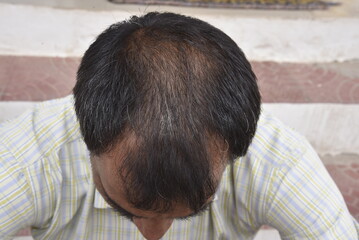 Hair loss problem - 778098634