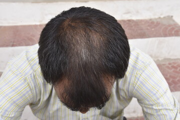 Hair loss problem - 778098673