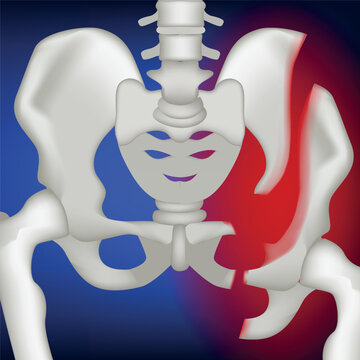 Human pelvic fracture on a blue glowing background. Realistic rendering of bones. Medical poster. Vector illustration