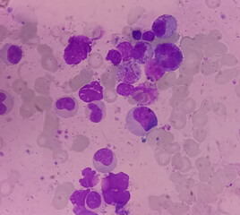 Bone marrow study. Reactive marrow with dimorphic erythroid hyperplasia.