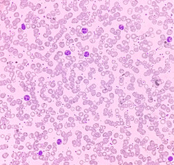 Bone marrow study. Reactive marrow with dimorphic erythroid hyperplasia.