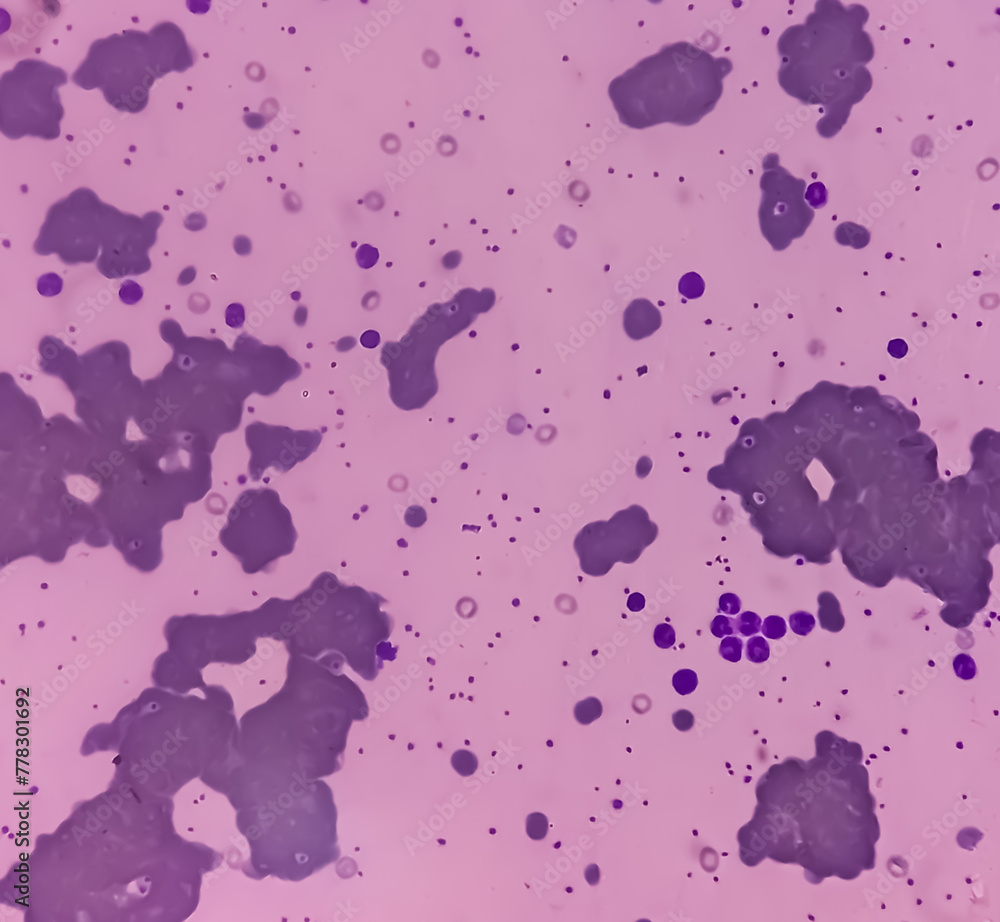 Canvas Prints Cold agglutinins disease, RBCs to clump together (agglutinate) at low temperatures, autoimmune hemolytic anemia, anisocytosis anisochromia with macrocytes echinocytes seen. macrocytic anemia.