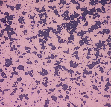 Cold agglutinins disease, RBCs to clump together (agglutinate) at low temperatures, autoimmune hemolytic anemia, anisocytosis anisochromia with macrocytes echinocytes seen. macrocytic anemia.