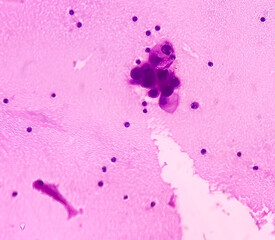 Ascitic fluid cancer. Metastatic adenocarcinoma. Smear show atypical epithelial cells, show...