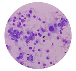 Bone merrow smear show 60 to 65 percent marrow nucleated cells. Macrocytic anemia. Plasma cell...