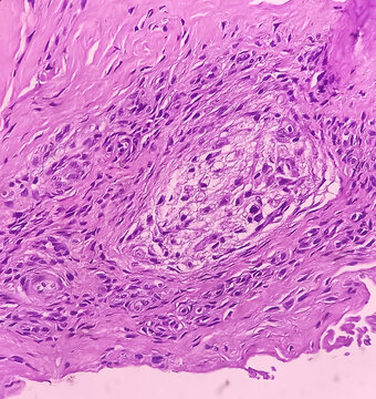 Tendon sheath (biopsy): Chronic synovitis. smear show area of fibrosis and infiltration of inflammatory cells. Villonodular synovitis.