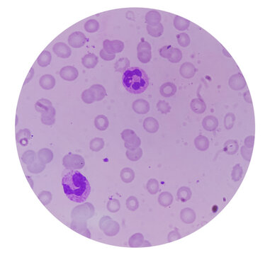 Blood smear show anisocytosis and target cells, Macrocytic anemia.