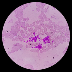 Blood smear show anisocytosis and target cells, Macrocytic anemia with thrombocytosis.