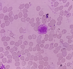 Blood smear show anisocytosis and target cells, Macrocytic anemia.
