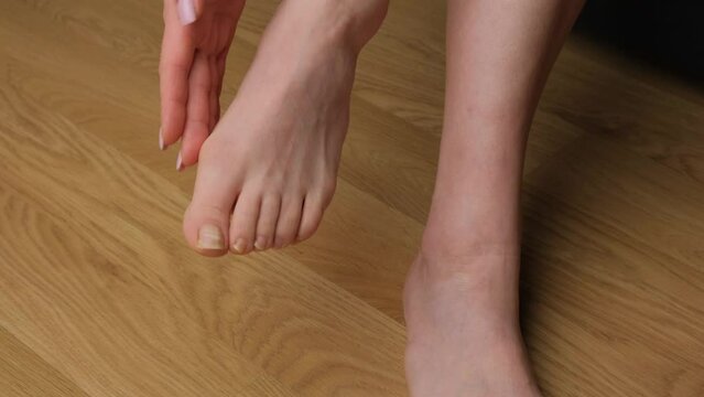 Close-up of a woman's feet with hallux valgus.