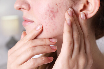 Woman with acne problem at home, closeup