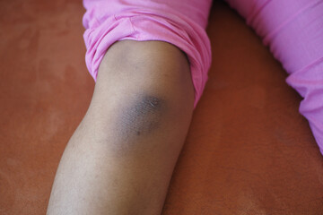 stain bruise wound on kid knee.