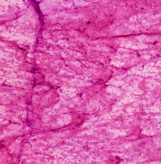 Cytological study of Abdominal mass: Spindle cell neoplasm, smear show cellular material of oval to spindle shaped cells, mild pleomorphism, blood.