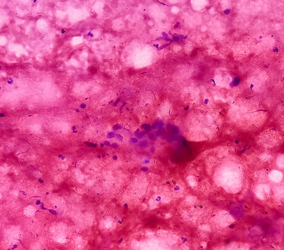 FNA from paravertebral mass. Suppurative inflammation. Smear show plenty of degenerated and intact polymorphs, lymphocytes and histiocytes.
