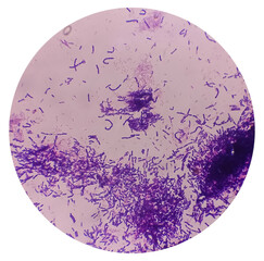 Yeast Infection; Budding yeast and pseudohyphae of Candida albicans, gram's stain. This fungus...