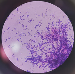 Yeast Infection; Budding yeast and pseudohyphae of Candida albicans, gram's stain. This fungus...